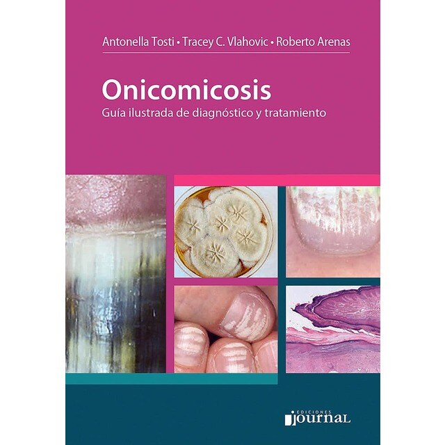 Onicomicosis.pdf