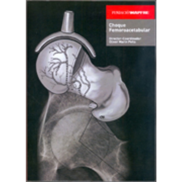 Choque femoracetabular (Tapa blanda)